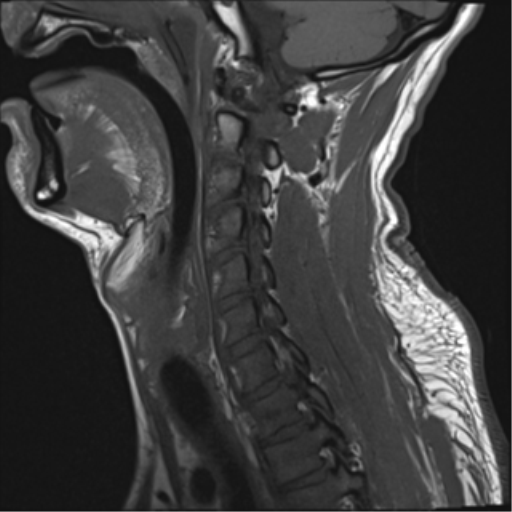 File:Cavernoma of cervical cord (Radiopaedia 50838-56347 Sagittal T1 11).png