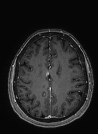 File:Cavernous hemangioma of the cerebellar falx (Radiopaedia 73025-83724 Axial T1 C+ 104).jpg