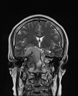 File:Cavernous sinus meningioma (Radiopaedia 63682-72367 Coronal T2 8).jpg