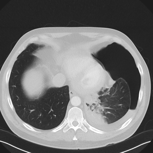 Cavitating pneumonia complicated by pneumothorax (Radiopaedia 48149-52994 Axial lung window 51).png