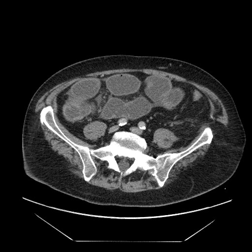 File:Cecal adenocarcinoma (Radiopaedia 64871-73817 A 67).jpg