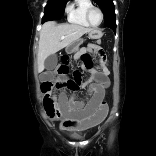 Cecal adenocarcinoma (Radiopaedia 75909-87331 B 17).jpg