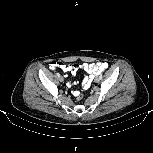 Cecal adenocarcinoma (Radiopaedia 85324-100916 B 83).jpg