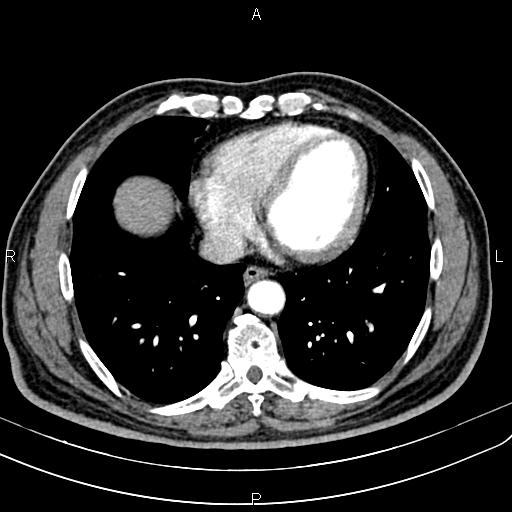 File:Cecal cancer with appendiceal mucocele (Radiopaedia 91080-108651 A 47).jpg