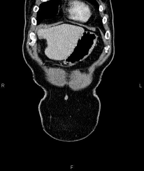 Cecal cancer with appendiceal mucocele (Radiopaedia 91080-108651 D 7).jpg