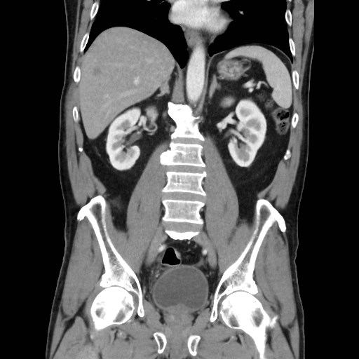 Cecal mass causing appendicitis (Radiopaedia 59207-66531 B 31).jpg