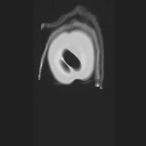 Cecal volvulus (Radiopaedia 75378-86620 Coronal lung window 10).jpg