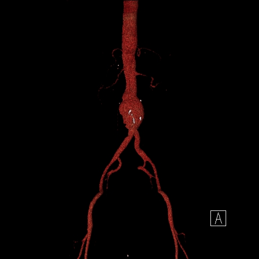 File:Celiac artery compression by the diaphragmatic crurae (Radiopaedia 31739-32666 3D CTA 1).jpg