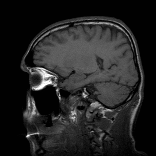 File:Central-variant posterior reversible encephalopathy syndrome (PRES) (Radiopaedia 43880-47359 Sagittal T1 16).jpg