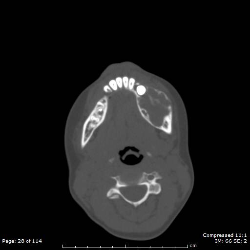 File:Central giant cell granuloma (Radiopaedia 45612-49754 Axial bone window 14).jpg