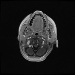 Central neurocytoma (Radiopaedia 30220-30842 Axial T1 C+ 13).jpg