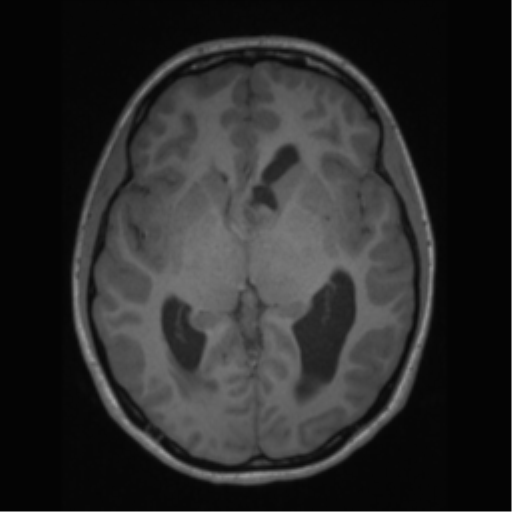File:Central neurocytoma (Radiopaedia 37664-39557 Axial T1 34).png