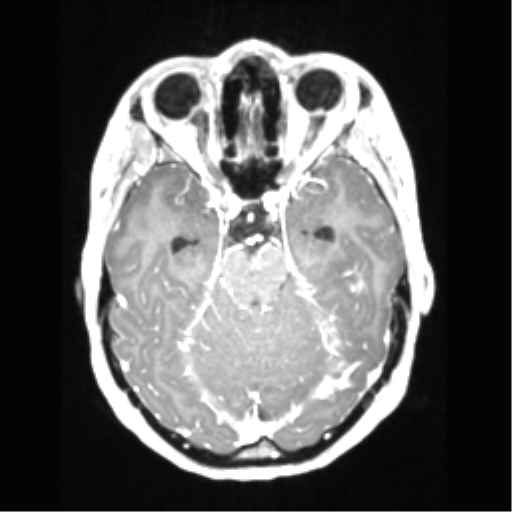 Central neurocytoma (Radiopaedia 37664-39557 Axial T1 C+ 29).png