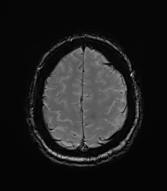 Central neurocytoma (Radiopaedia 71068-81303 Axial SWI 55).jpg