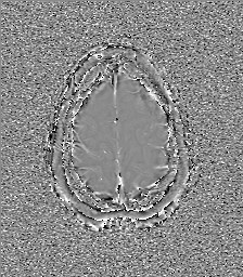 File:Central neurocytoma (Radiopaedia 84497-99872 Axial 63).jpg