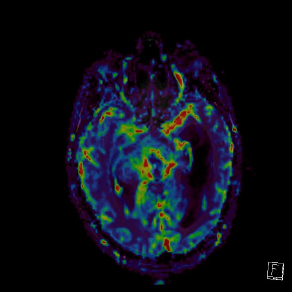 Central neurocytoma (Radiopaedia 84497-99872 Axial Perfusion 189).jpg