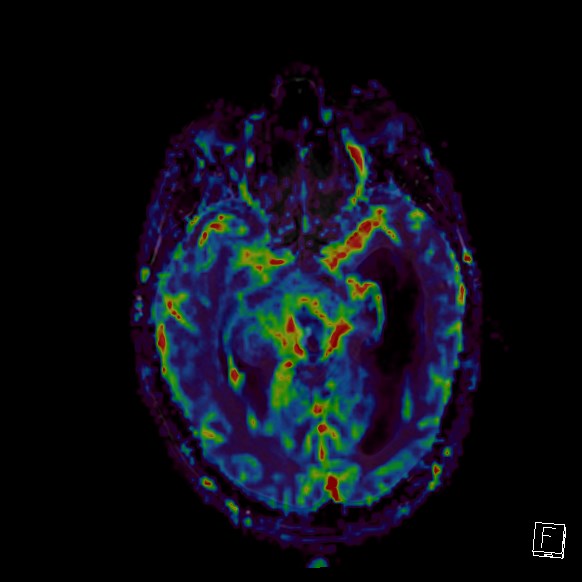 Central neurocytoma (Radiopaedia 84497-99872 Axial Perfusion 190).jpg