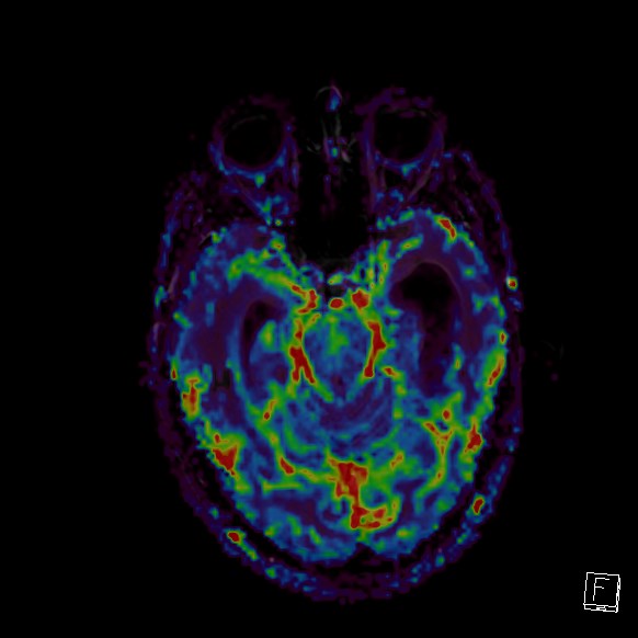 Central neurocytoma (Radiopaedia 84497-99872 Axial Perfusion 209).jpg