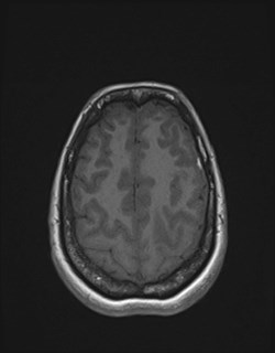 File:Central neurocytoma (Radiopaedia 84497-99872 Axial T1 157).jpg
