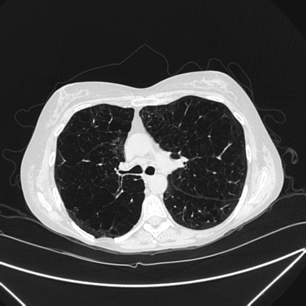 Centrilobular pulmonary emphysema (Radiopaedia 24495-24789 Axial lung window 38).jpg