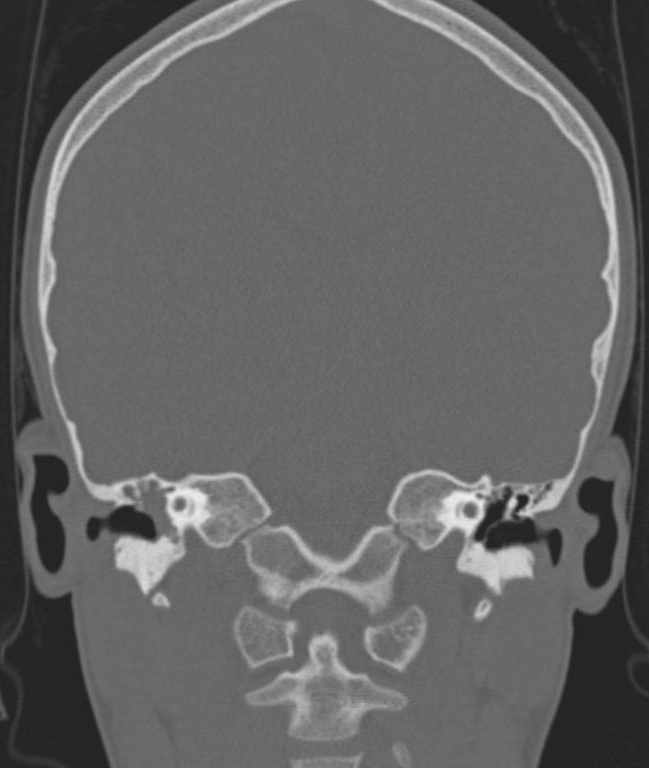 Cerebellar abscess (Radiopaedia 73727-84527 Coronal bone window 68).jpg