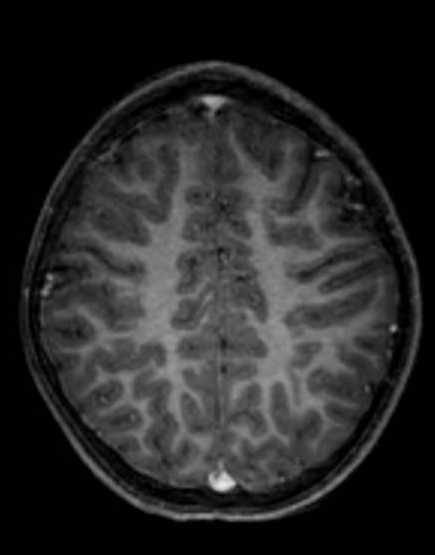 Cerebellar abscess (Radiopaedia 73727-84563 Axial T1 C+ fat sat 83).jpg