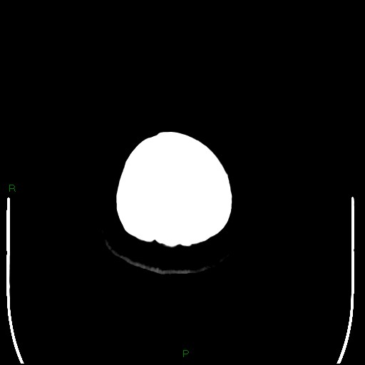 Cerebellar abscess (Radiopaedia 78135-90671 Axial non-contrast 112).jpg