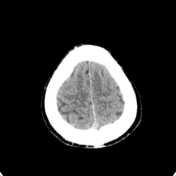 Cerebellar abscess secondary to mastoiditis (Radiopaedia 26284-26412 Axial non-contrast 141).jpg