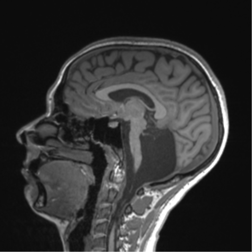Cerebellar agenesis with hypoplastic pons (pontocerebellar hypoplasia) (Radiopaedia 57224-64138 Sagittal T1 37).png