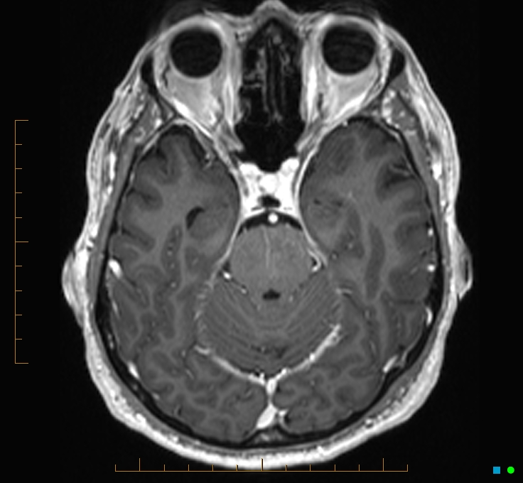 Cerebellar gangliocytoma (Radiopaedia 65377-74422 Axial T1 C+ 40).jpg