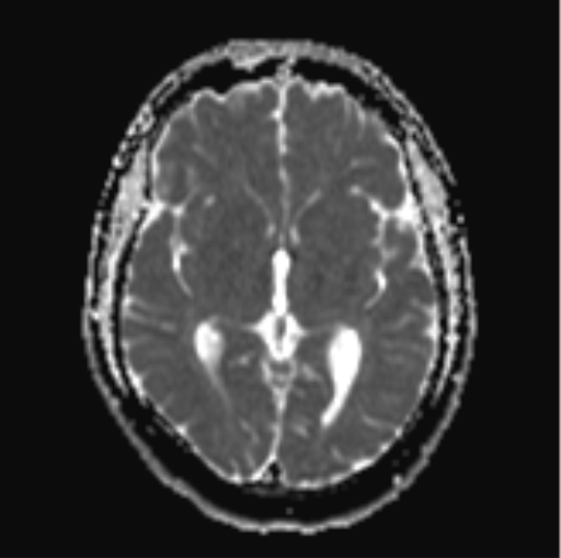File:Cerebellar hemangioblastomas and pituitary adenoma (Radiopaedia 85490-101176 Axial ADC 17).png
