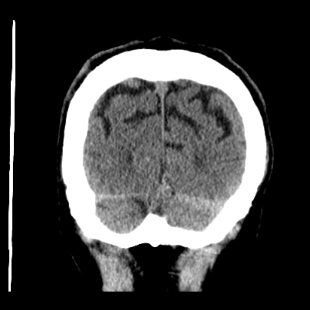 Cerebellar hemorrhage (Radiopaedia 27193-27359 Coronal non-contrast 50).jpg