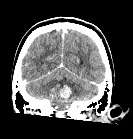 Cerebellar metastases - colorectal adenocarcinoma (Radiopaedia 40947-43652 Coronal C+ 69).png