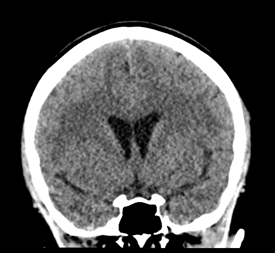 Cerebellar metastases - colorectal adenocarcinoma (Radiopaedia 40947-43652 Coronal non-contrast 42).png
