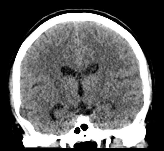 Cerebellar metastases - colorectal adenocarcinoma (Radiopaedia 40947-43652 Coronal non-contrast 51).png