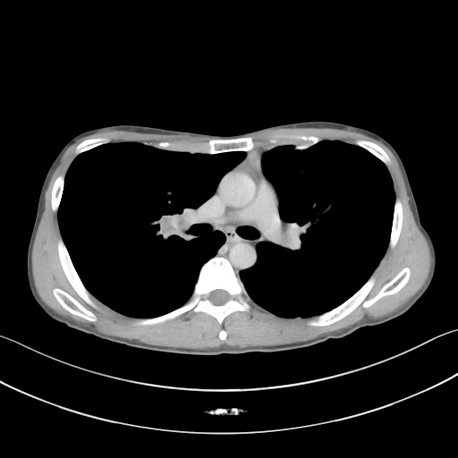Cerebellar metastasis - adenocarcinoma lung (Radiopaedia 63184-71717 Axial C+ delayed 30).png