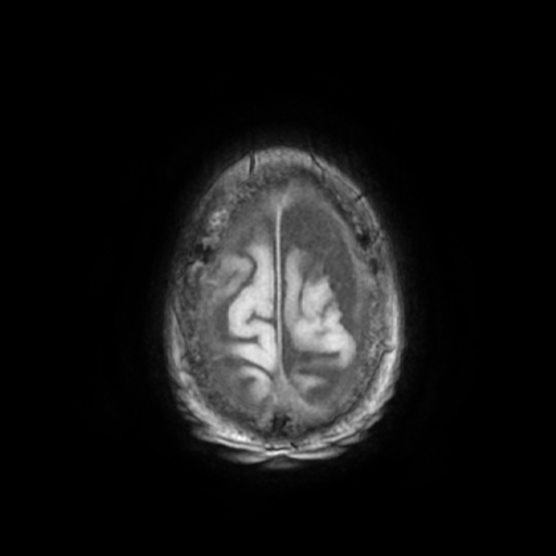 File:Cerebellar metastasis - lung tumor (Radiopaedia 69317-79147 Axial T1 31).jpg