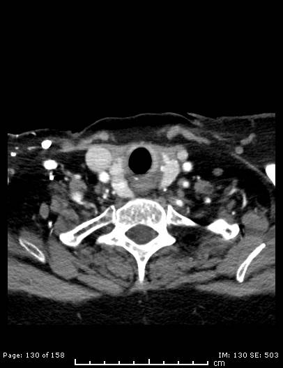 File:Cerebellar strokes due to intracranial giant cell arteritis (Radiopaedia 68799-78510 CT angiogram 130).jpg