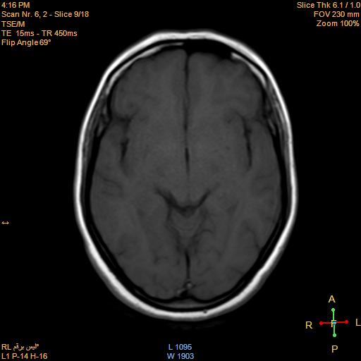 File:Cerebellopontine angle meningioma (Radiopaedia 22488-22525 Axial T1 8).jpg