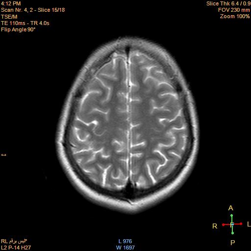File:Cerebellopontine angle meningioma (Radiopaedia 22488-22525 Axial T2 13).jpg