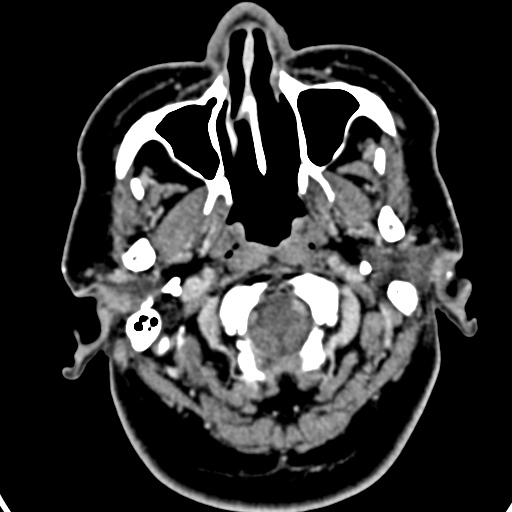 Cerebellopontine angle meningioma (Radiopaedia 35181-36714 A 58).jpg