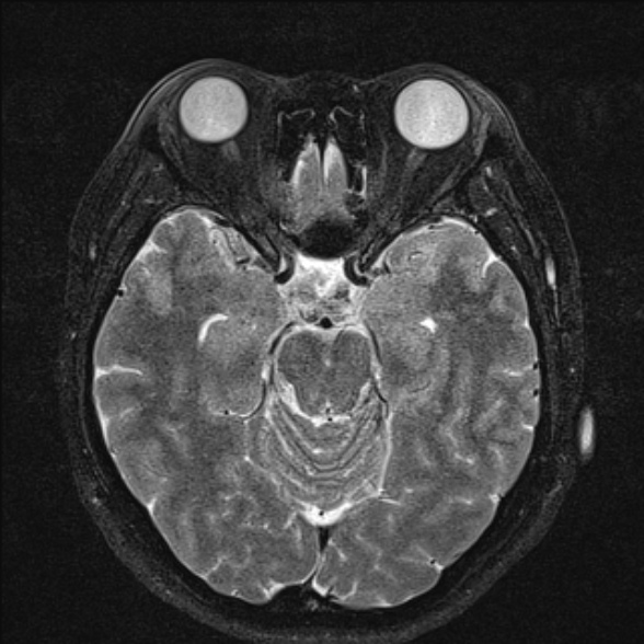 File:Cerebellopontine angle meningioma (Radiopaedia 53561-59591 Axial T2 fat sat 19).jpg