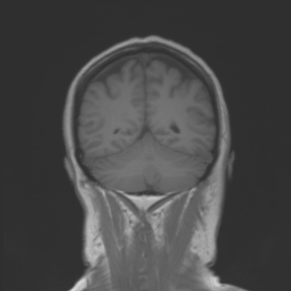File:Cerebellopontine angle meningioma (Radiopaedia 53561-59591 Coronal T1 18).jpg