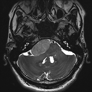 Cerebellopontine angle meningioma (Radiopaedia 72983-83680 Axial FIESTA 24).jpg