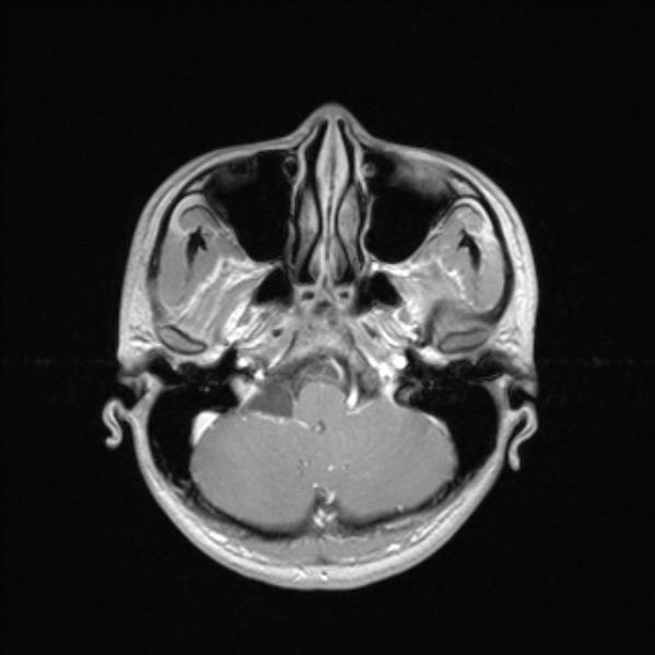 Cerebral abscess (Radiopaedia 24212-24478 Axial T1 C+ 16).jpg