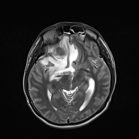 Cerebral abscess (Radiopaedia 24212-24478 Axial T2 29).jpg