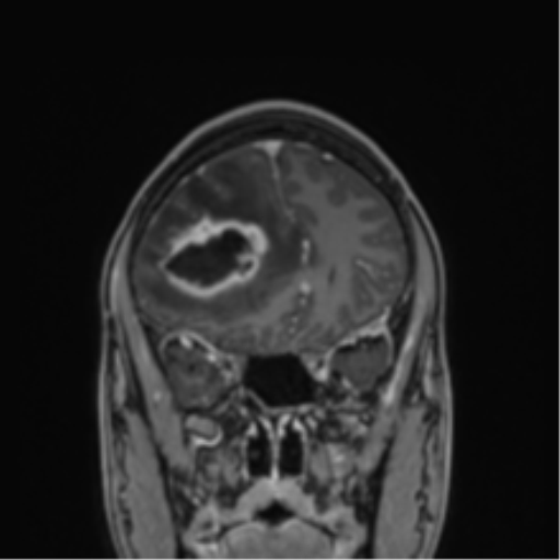 Cerebral abscess (Radiopaedia 60342-68009 H 38).png