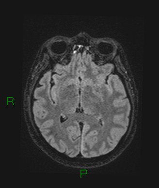 Cerebral abscess and subdural empyema (Radiopaedia 84436-99779 Axial FLAIR 45).jpg