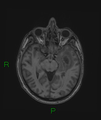 Cerebral abscess and subdural empyema (Radiopaedia 84436-99779 Axial T1 50).jpg
