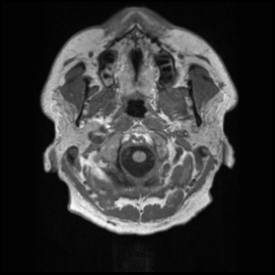 File:Cerebral abscess with ventriculitis (Radiopaedia 78965-91878 Axial T1 1).jpg
